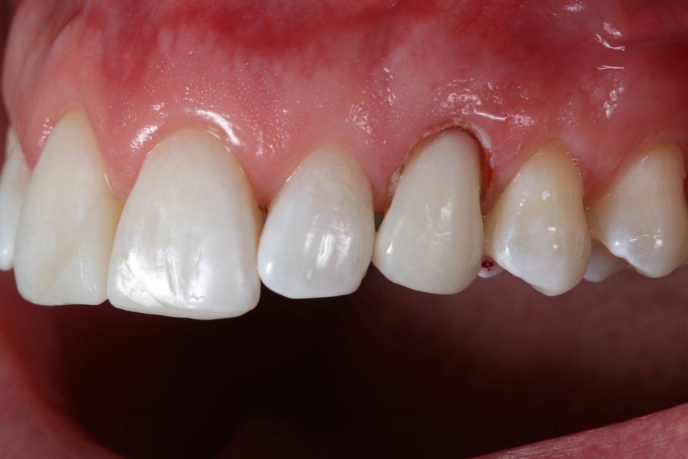The Use Of Lasers In Dentistry Gingivectomy By Diode Laser Optident